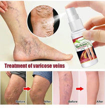 Cargar imagen en el visor de la galería, Varicose Veins Treatment Spray