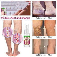 Cargar imagen en el visor de la galería, Varicose Veins Treatment Spray
