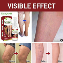 Cargar imagen en el visor de la galería, Varicose Veins Treatment Spray